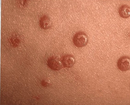 מולוסקום -יבלות ויראליות2